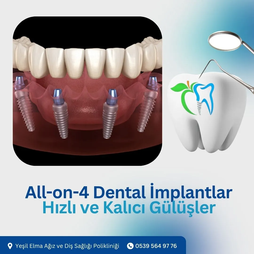 All-on-4 Dental İmplantlar