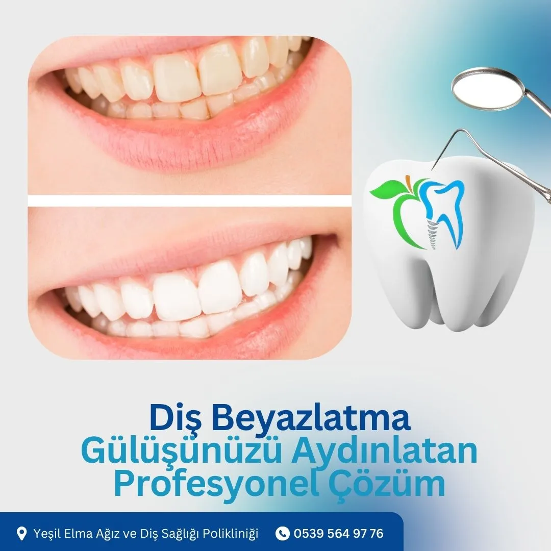 Diş Beyazlatma