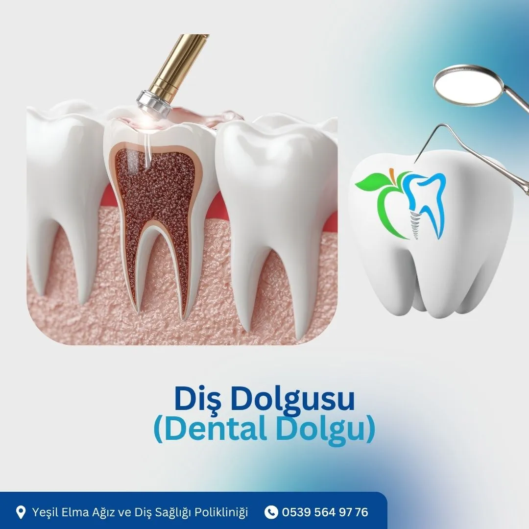 Diş Dolgusu (Dental Dolgu)