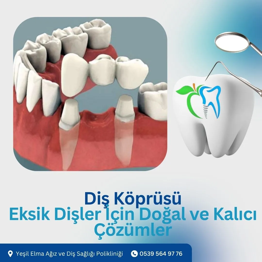 Diş Köprüsü