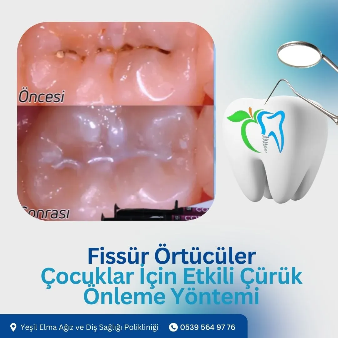 Fissür Örtücüler