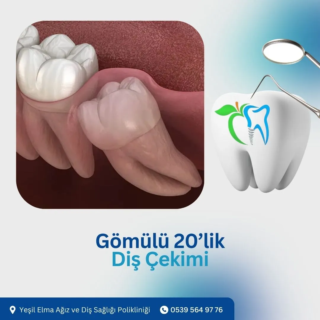 Gömülü 20’lik Diş Çekimi
