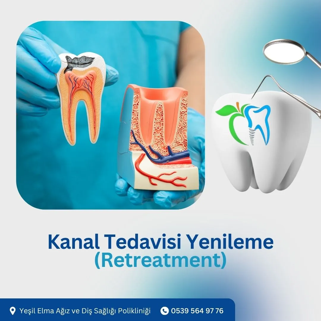 Kanal Tedavisi Yenileme (Retreatment)