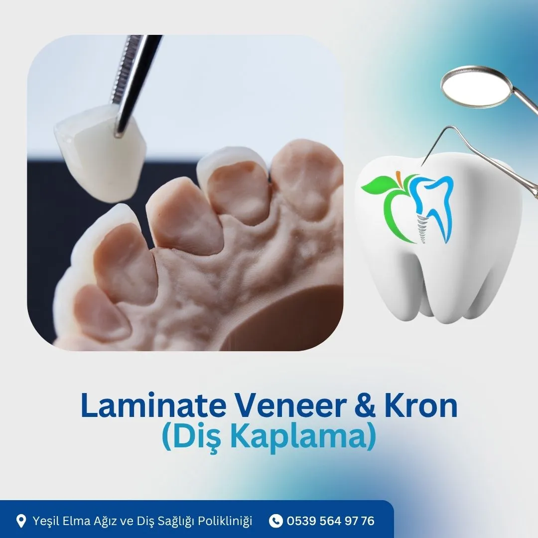 Laminate Veneer & Kron (Diş Kaplama)
